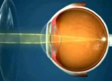 Lazerle gözlükten kurtulma tedavisinde kullanılan yöntemler
