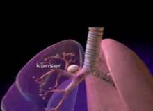 Akciğer amfizeminin tedavisi nasıldır?