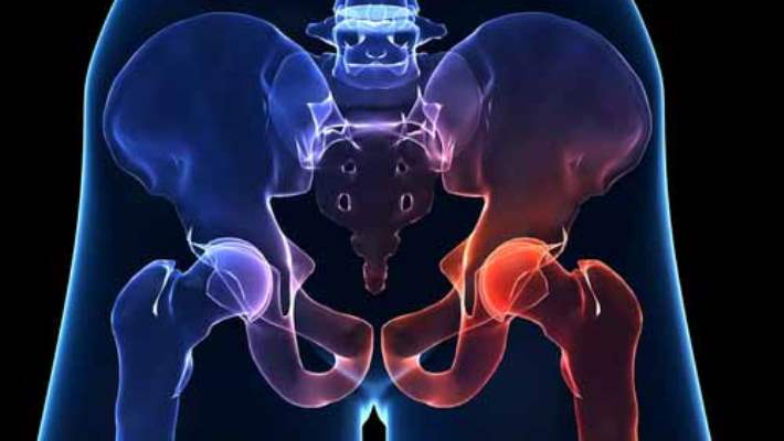 Büyükbabanın Kırık Kalçası Torunun Kemiklerini Zayıflatabilir