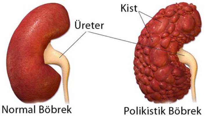 Batı Nil Virüsü Böbreklerde Kalabilir