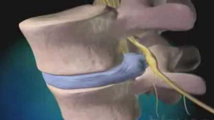 Ozon İle Bel Fıtığı Tedavisi