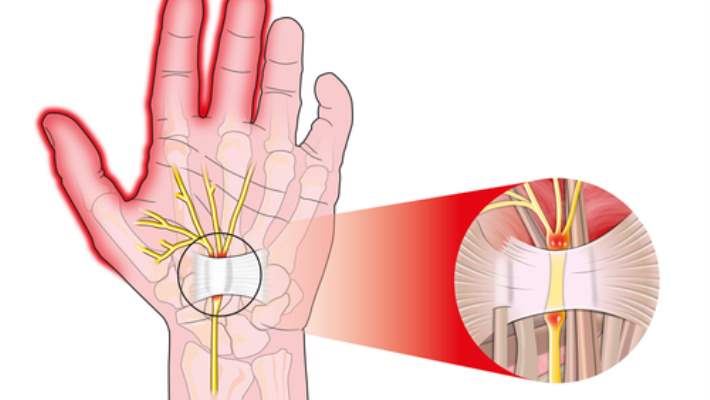 Sinir Sıkışması Tedavisi Egzersizleri