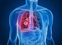 Akciğer Embolisinin Belirtileri Nelerdir? Akciğer Embolisinin Belirtileri Nelerdir?
