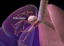 Akciğer Embolisinin Tedavisi Nasıl Yapılır? Akciğer Embolisinin Tedavisi Nasıl Yapılır?