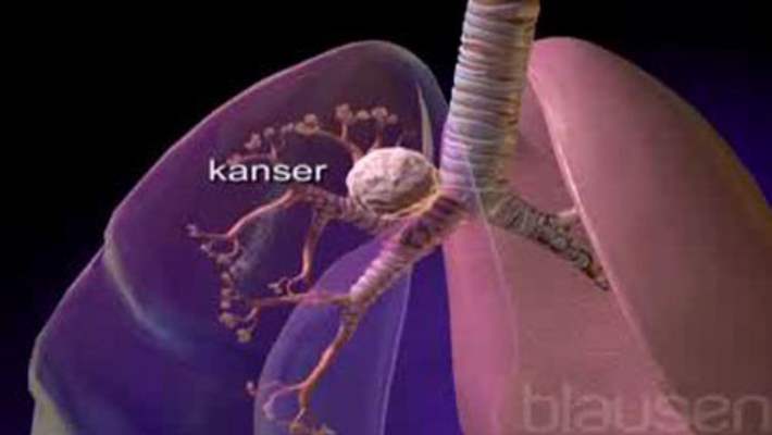 Akciğer Embolisinin Tedavisi Nasıl Yapılır?