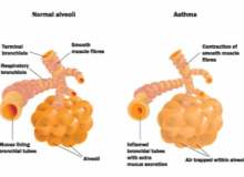 Akciğer Embolisinde Aspirin Kullanılmaz