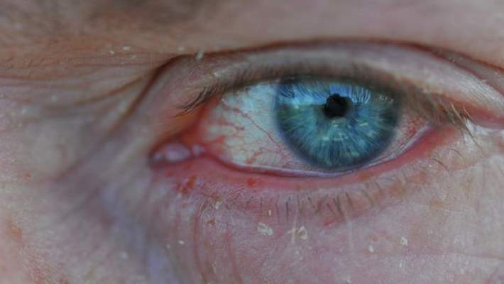İleri Yaşlarda Sık Rastlanan Göz Hastalıkları