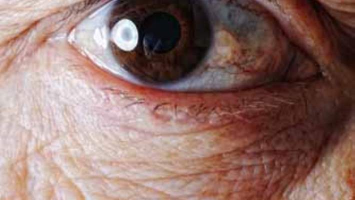 Kataraktın Nedenleri Nelerdir?