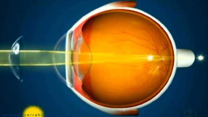 Keratokonus Tedavisi Yöntemleri