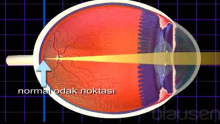 Sarı Nokta Hastalığının Teşhisi