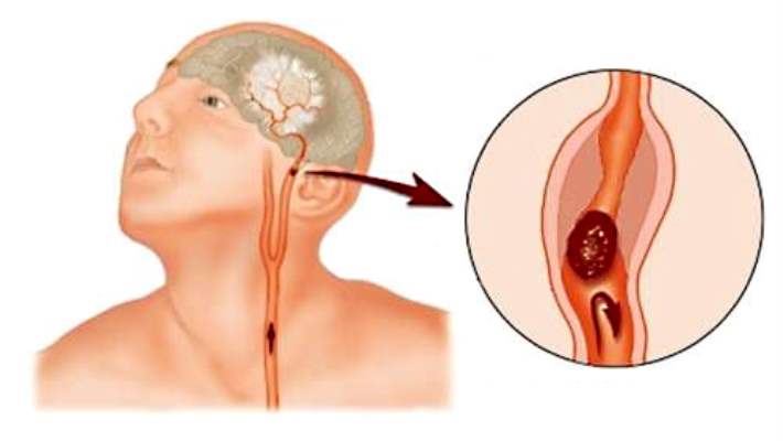 Beyin Kanaması Sırasında Yapılması Gerekenler