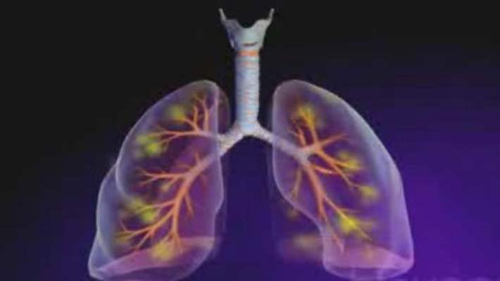 Erişkinlerde Zatürre