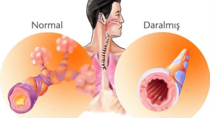 Kronik Bronşitin Tedavisi