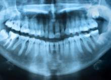 Yirmi yaş dişinin çekilmesi gereken durumlar hangileridir?