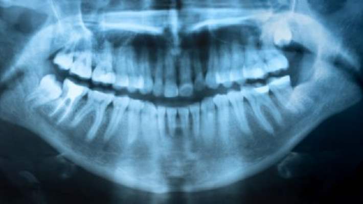 Yirmi Yaş Dişinin Çekilmesi Gereken Durumlar Hangileridir?