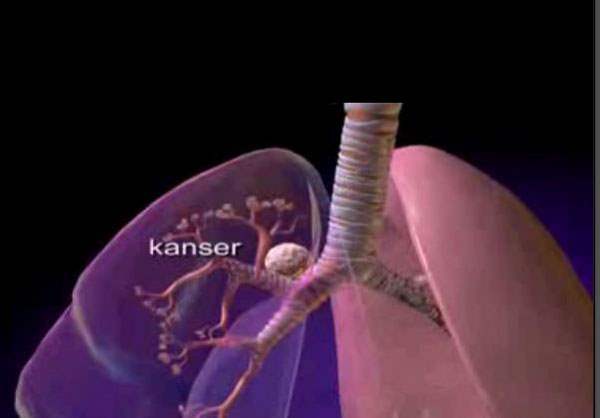 Akciğer kanserine benzer belirti veren hastalıklar