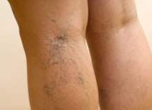 Varis Ölüme Yol Açabilir Varis Ölüme Yol Açabilir