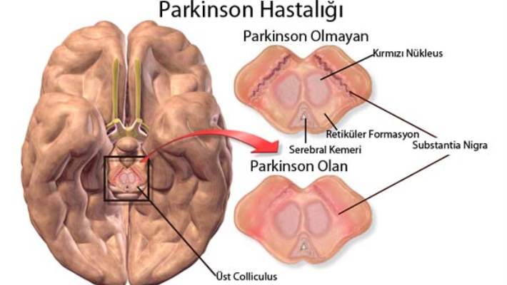 Parkinson Teşhisinin Konulması
