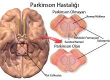 Parkinsonda gen tedavisi