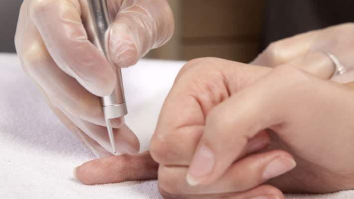 Siğilin Tedaviden Sonra Tekrarlama Riski Nedir?