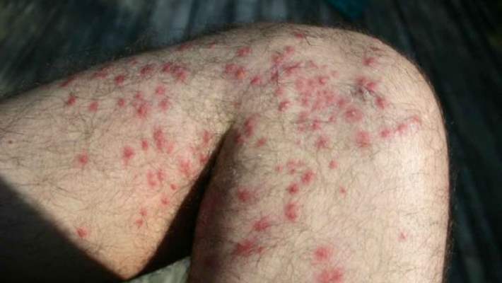 Behçet Hastalığı En Sık Hangi Yaşlarda Görülür?