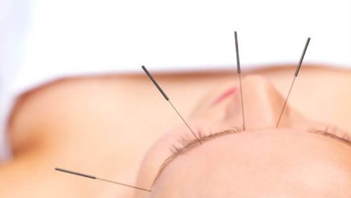 Akupunktur İle Baş Ağrısı Tedavisi