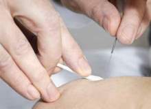 Akupunktur ile baş ağrısı tedavisinin süresi
