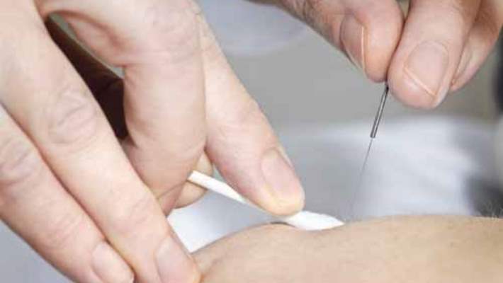 Akupunktur İle Baş Ağrısı Tedavisinin Süresi