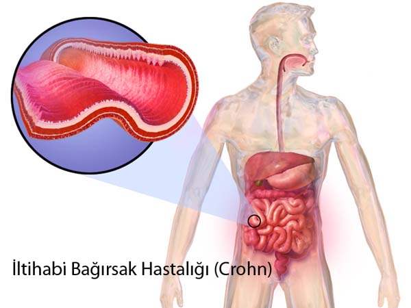 Crohn Hastalığı İle Omurga Problemleri Arasındaki Bağ