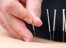 Akupunktur ile baş ağrısı ve migren tedavisinde ne tür iğneler kullanılır?