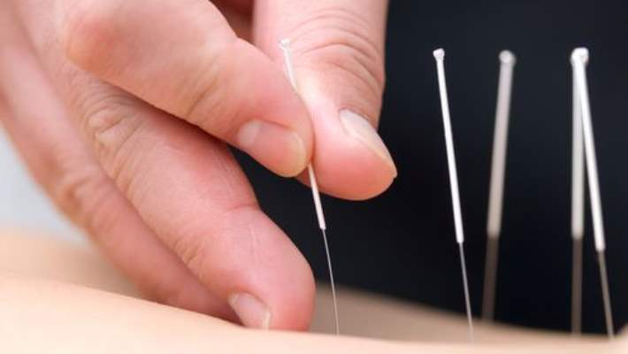 Akupunktur İle Baş Ağrısı Ve Migren Tedavisinde Ne Tür İğneler Kullanılır?