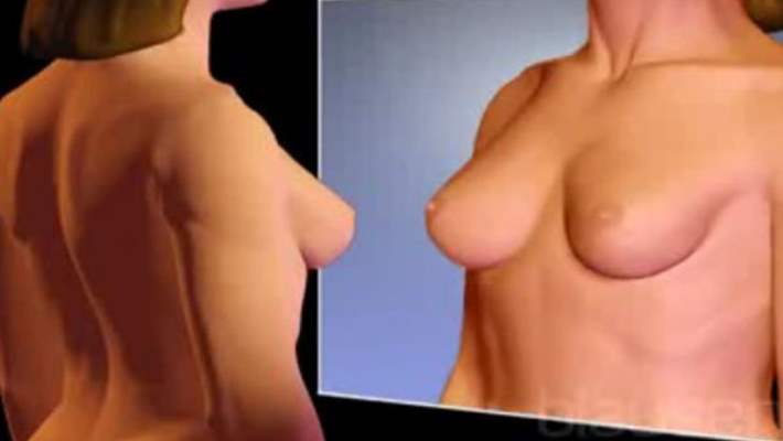 Meme Kanseri Tedavisinde Kemoterapi Uygulaması