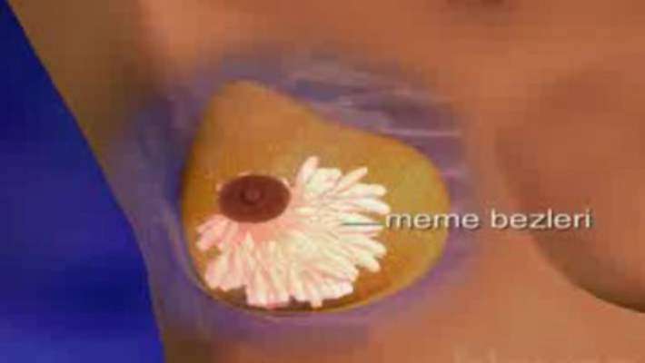 Meme Kanseri Tedavisinde Yeni Teknikler