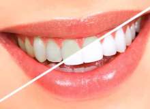Diş beyazlatmada uygulanan işlemler nelerdir?