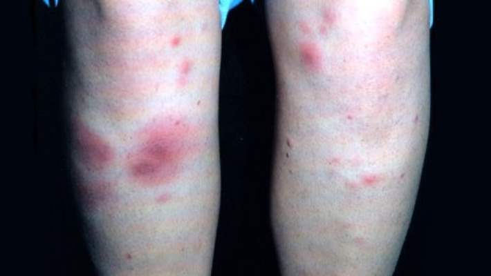 Sedef Hastalığının Nedenleri