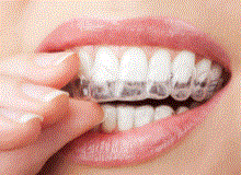 Diş beyazlatma işlemini kimler yaptırabilir?