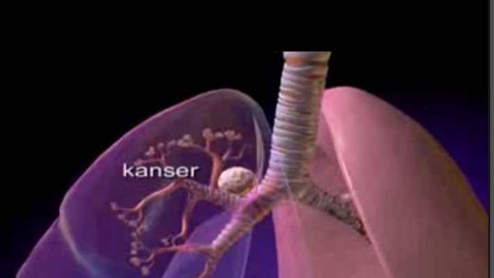Akciğer Kanseri Diğer Kanserlerden Daha Kötü Seyreder