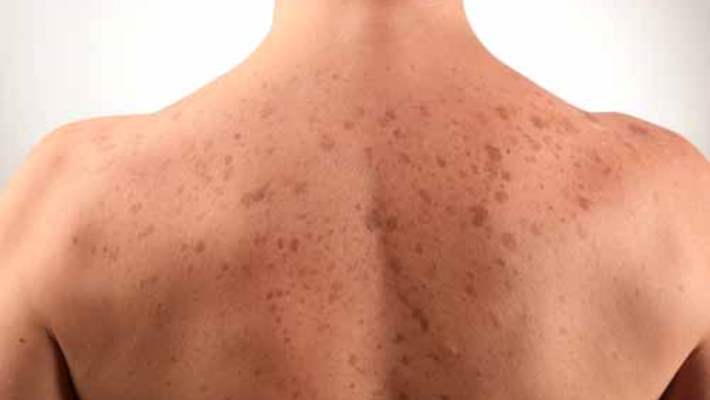 Cilt Kanserinin İlaçla Tedavisi