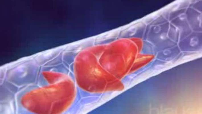 Akdeniz Anemisi Tedavisinde Kök Hücre Nakli