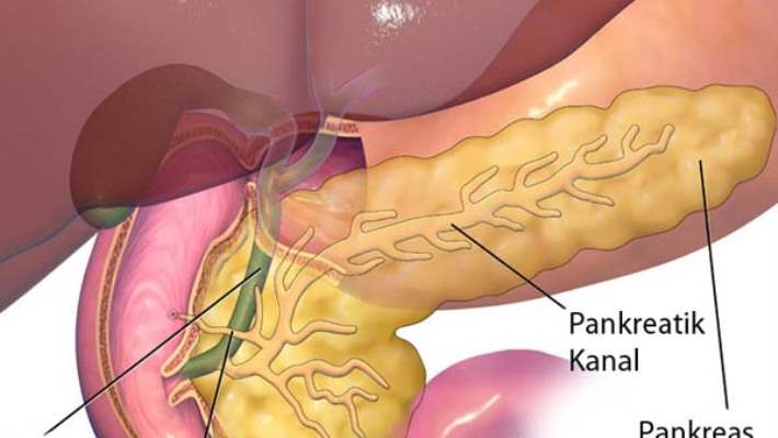 Pankreas Kanserinin Teşhisi Nasıldır