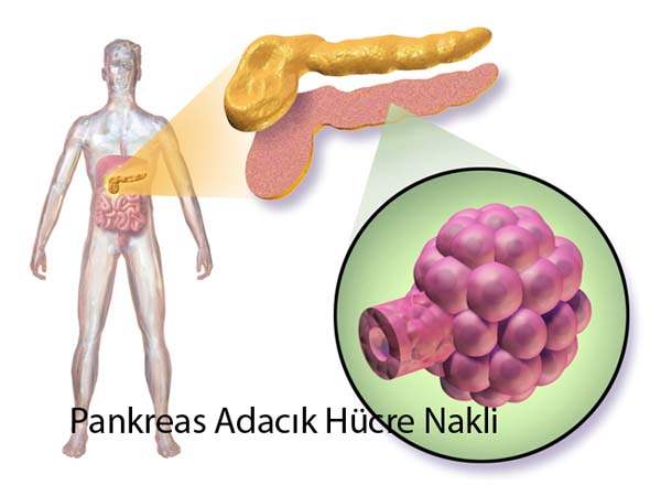 Pankreas Kanseri Ameliyatı Sonrası