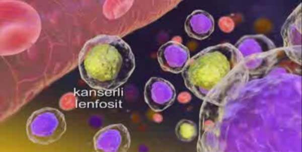 Lösemi Tedavisinde Kemoterapi Uygulaması