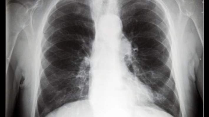 Akciğer Kanseri Teşhisi