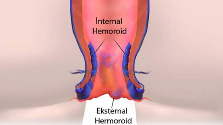 Hemoroid Tedavisi