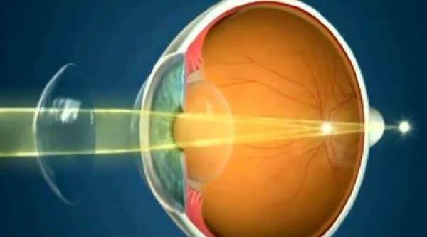 Göze uygun kontakt lens seçimi