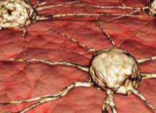 Beyin tümörünün özellikleri