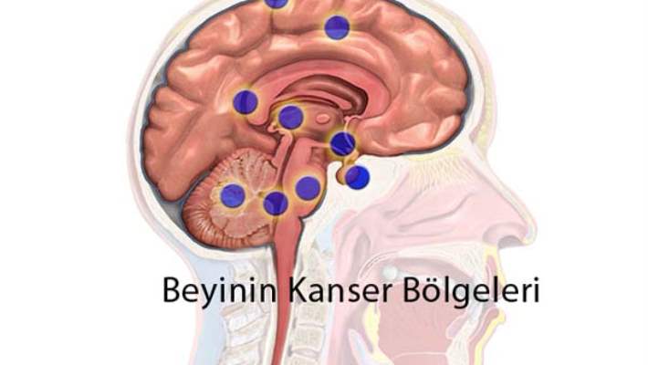 Beyin Tümörünün Nedenleri