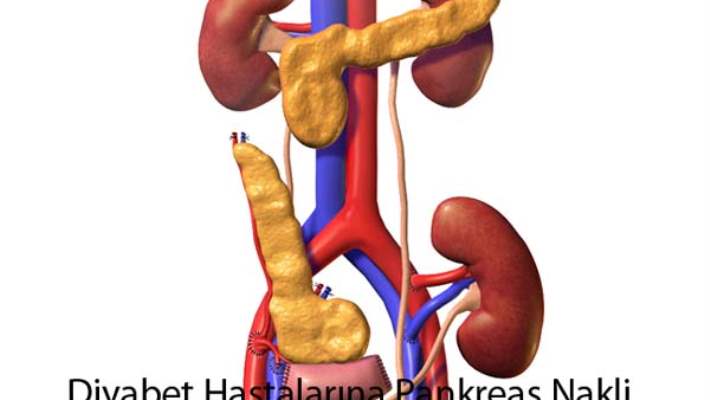 Pankreas Kanseri Nedir?