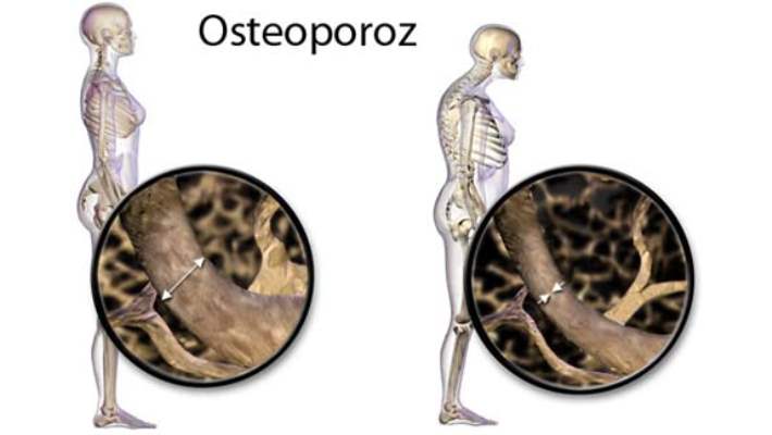 Araştırmalar Osteoporoz Genini Saptamaya Yardımcı Oluyor