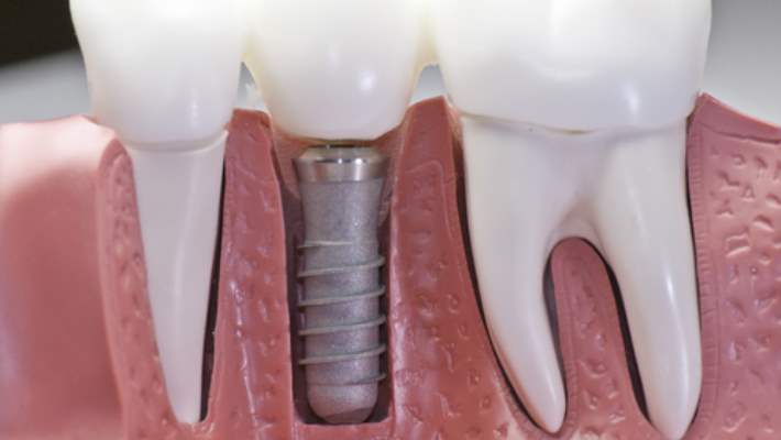 Diş İmplantı Ve Farklı Tasarımları Nelerdir?